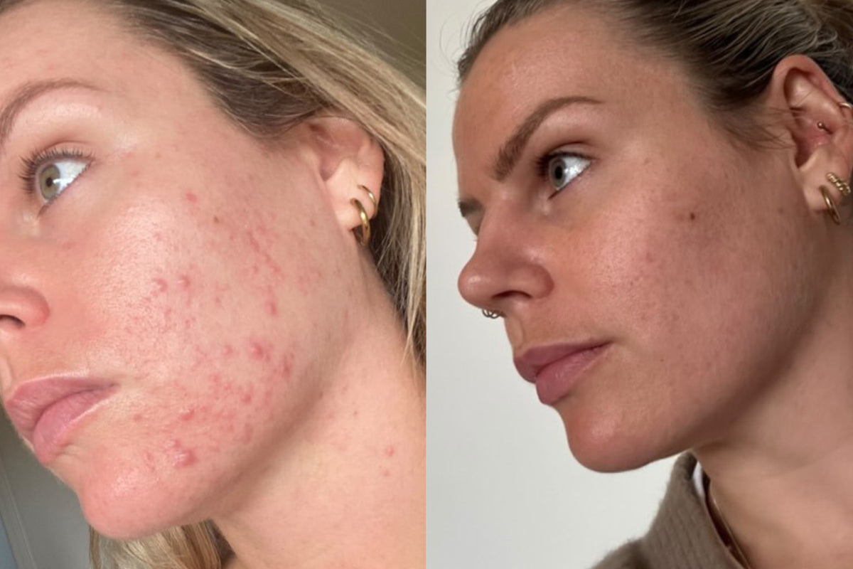 A before and after image of a lady who had acne and as a result of using Love to b skincare products her skin is now clear as shown on the right